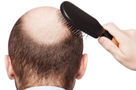 Parlando di capelli maschili, la . Ricrescita Capelli Uomo Come Curare La Caduta Naturalmente