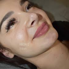 Surgical Lip Lift!? This isn't the result of filler, this isn't a surgical  lip lift, this is a lip blush tattoo. A result that some end up paying tens  of thousands for