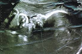 First trimester screening includes an ultrasound exam to measure the size of the clear space in the tissue at the back of a baby's neck (nuchal translucency). What Was Going Wrong With My Pregnancy Wsj