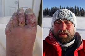 I lost my toes to frostbite — and donated them to a bar