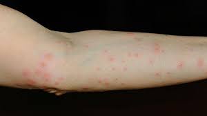 Some of these species spin silk and form webs, mostly to protect their eggs and young from predators. What Bit Me How To Identify Common Bug Bites Everyday Health