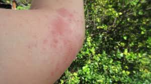 Image result for zinc burn in plants