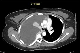 Thoracic endometriosis is an uncommon location for endometriosis and the main cause of catamenial pneumothorax. Thoracic Endometriosis A Clinical Review And Update Of Current And Evolving Diagnostic And Therapeutic Techniques Springerlink