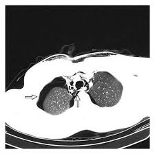 Image result for Intrapleural Anesthesia