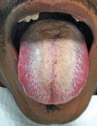 Hairy tongue, referred to as lingua villosa in medical lexicon, is a fairly common condition. Can You Discuss Treatment For Black Hairy Tongue Besides Scraping Dimensions Of Dental Hygiene