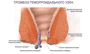 Mozhet Li Byt Temperatura Pri Gemorroe Prichiny I Lechenie Oficialnyj Sajt Gbuz Rodilnyj Dom 2 G Magnitogorsk