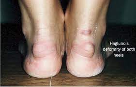 A haglund's deformity is a bump in the back of the heel bone. Haglund S Deformity Conservative Treatment Options Myfootshop Com