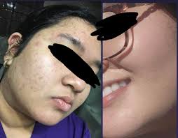 How to fix these pigmentations 😑...!!!!! My Worst insecurity