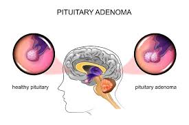 Kelenjar paratiroid pada tenggorokan membuat hormon (pth), gangguan termasuk hiperparatiroidisme dan hipoparatiroidisme empat kelenjar paratiroid kecil berada. Patofisiologi Tumor Pituitari Alomedika