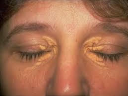 Dünyanın en büyük sosyal hikaye anlatıcılığı platformu wattpad'deki en popüler taekook hikayeleri okuyun. Xantelazma Neboli Bile Tukove Usazeniny Bile Fleky A Skvrny V Okoli Oci Jak Na Ne Rehabilitace Info