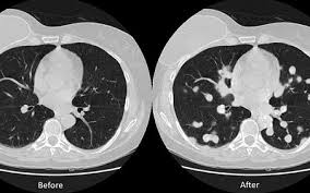 The national average cost for a ct scan is $5,750, but it's not always easy to figure out what different healthcare facilities charge for the procedure. Israeli Researchers Show Medical Scans Vulnerable To Fake Tumors The Times Of Israel