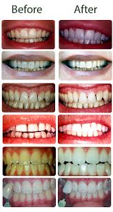 Tooth bleaching will remove stains from the surface of the teeth and return them to the colour they were originally prior to staining. Before And After Examples Life Like Teeth Whitening Products Made Exclusively For Dentists