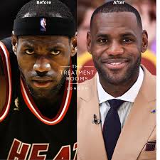 Lebron James Hair Transplant: Before and After Analysis