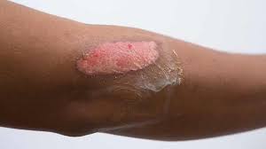 We did not find results for: Burns Types Symptoms And Treatments