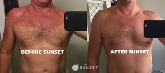The best, cheapest and the only permanent solution for asian glow is to avoid drinking alcohol in order to get rid of the flush reaction and other symptoms. Sunset Alcohol Flush Support Asian Flush Pill No Glow Pill