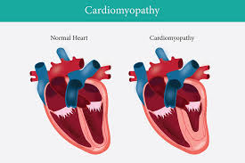 Image result for Cardiomyopathy