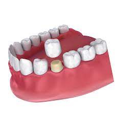 Check spelling or type a new query. Sensitivity After Dental Crown Treatment Boston Ma