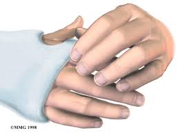 If you touch or squeeze it, you will cause the skin apply nonprescription medications. Cast Care Eorthopod Com