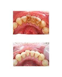 Evde diş beyazlatmak için kullanılan sayısız yöntem vardır. Dis Tasi Temizligi Zararli Midir Neden Yapilmalidir Dentnatural