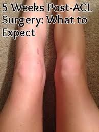 Acl Post Surgery Week 5 Nina Elise Yoga Fitness Knee Surgery Recovery Acl Surgery Meniscus Surgery Recovery