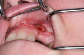 Image result for Bisphosphonates