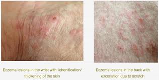 Image result for contact dermatitis