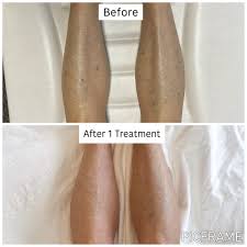 Image result for liver spots on legs