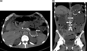 Scientific And Educational Abstracts Presented At The 30th Anniversary Aser 2018 Annual Scientific Meeting And Postgraduate Course In Emergency And Trauma Radiology September 26 29 Mclean Virginia Springerlink