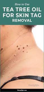 How To Remove Skin Tags With Tea Tree Oil Skin Tag Removal Skin Tags Essential Oils Tea Tree Oil Skin