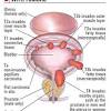 Bladder cancer, rare in children, happens when malignant cancer cells grow in tissues of the urinary bladder. 1