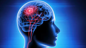 You may know somebody with a similar story: Mapping Out The Treatment Of Breast Cancer Related Brain Metastases On Medicine