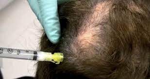 Cortisone injections are an important part of the treatment for many types of hair loss, including alopecia areata , lichen planopilaris , frontal fibrosing alopecia , central centrifugal cicatricial alopecia , discoid lupus , pseudopelade and traction alopecia. Steroid Injections Donovan Hair Clinic