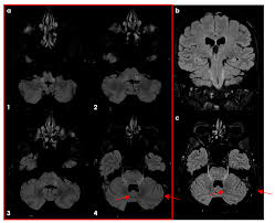 Image result for Neurologic Lesion Localization