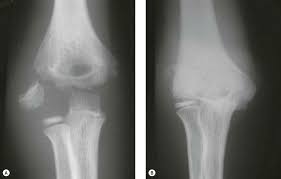 Image result for Lateral Condyle Fracture