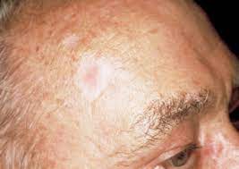 There are a number of different treatments doctors recommend. Basal Cell Carcinoma The Skin Cancer Foundation