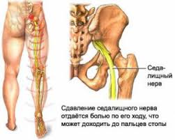 Zashemlenie Nerva V Spine Chto Delat I Chem Lechit Oficialnyj Sajt Gbuz Rodilnyj Dom 2 G Magnitogorsk