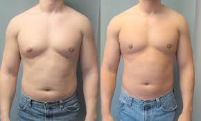 This means concentrating on a pectoral muscle workout plan. How To Cure Gynecomastia Quora