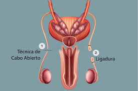 The cut ends of the vas may be tied, closed with a clip, or sealed by heat (cauterized). Vasectomia En Las Palmas De Gran Canaria Gabinete De Urologia Y Andrologia