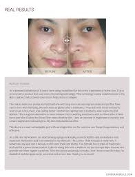 THE VIRAL REGENPEN™