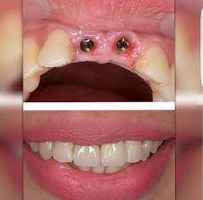 Implant gigi (dental implant) implant gigi merupakan gigi palsu permanen yang ditanam dalam gusi dan berdiri sendiri. Apa Itu Implan Gigi Rsgm Maranatha