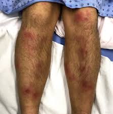 结节性红斑- 维基百科，自由的百科全书