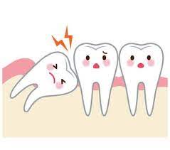 Medical wisdom tooth dentists dental surgeon dental surgeons dental surgery surgeries dental surgeries patient patients dentist teeth wisdom teeth health surgery pulling teeth tooth extraction. What You Need To Know About Extracting Your Wisdom Teeth All Star Dental