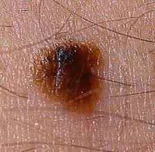 Medizin Leberflecke Zeugen Vom Alter Des Menschen Welt