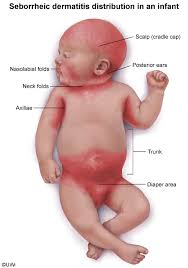 Image result for diaper dermatitis