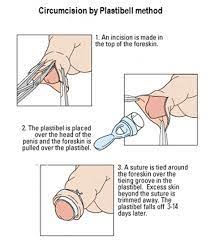 Ring Circumcision Method Circumcision Clinic Glasgow
