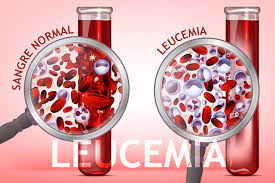 Estos tipos de cáncer se desarrollan en los glóbulos (células sanguíneas) o en otras células del cuerpo. La Leucemia Es El Cancer Que Afecta La Sangre Referencia Banco De Sangre