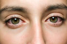 Vene Rosse negli Occhi: Come Rimediare | MBenessere