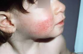 Maybe you would like to learn more about one of these? Syndroom Van Gianotti Crosti Huidarts Com