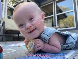 Avery Brantley was born prematurely and diagnosed with atrioventricular  septal defect. He was just a month old when he had his first open heart  surgery performed by Mark Bleiweis, MD, a congenital
