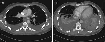 Maybe you would like to learn more about one of these? An Interesting Case Of Undiagnosed Pleural Effusion European Respiratory Society